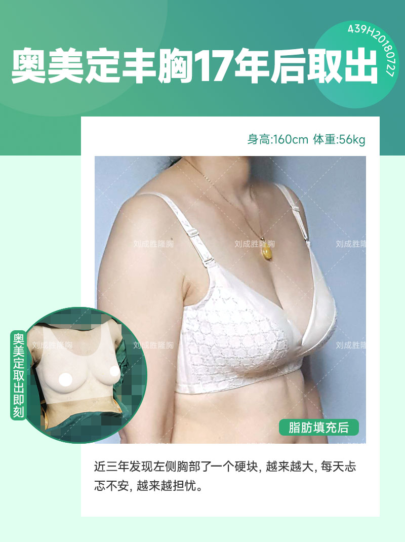 奥美定取出手术费用解析及影响因素